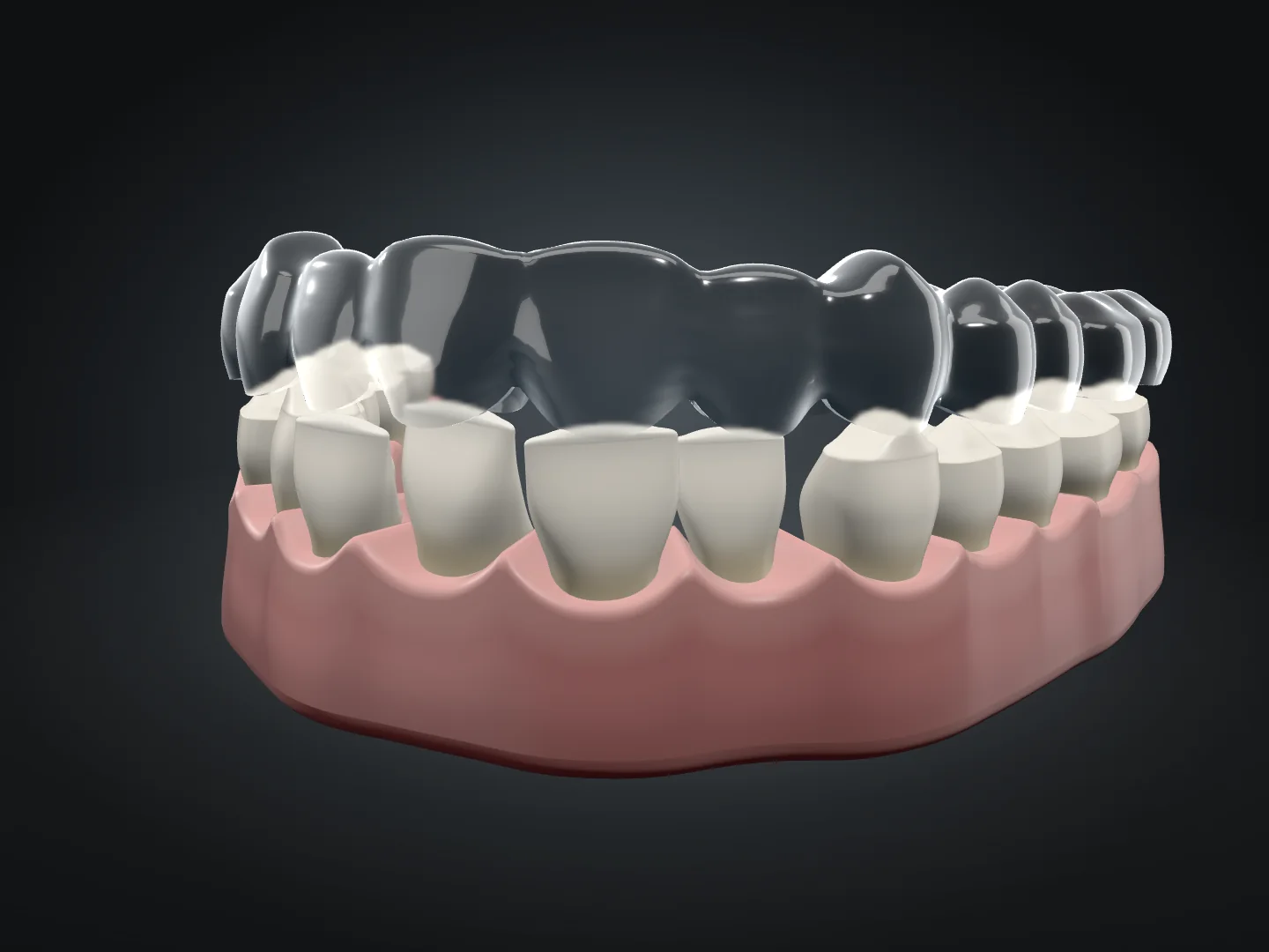 Illustrazione 3D di un’arcata dentale con una mascherina trasparente appoggiata sui denti